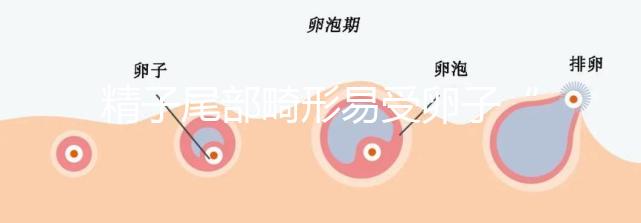 精子尾部畸形易受卵子“嫌棄”，無尾、短卷尾需重視