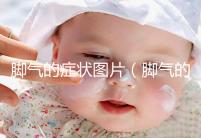 腳氣的癥狀圖片(腳氣的癥狀圖片,腳氣圖片大全)