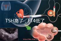 TSH高了，F(xiàn)T4低了，需要補碘嗎？